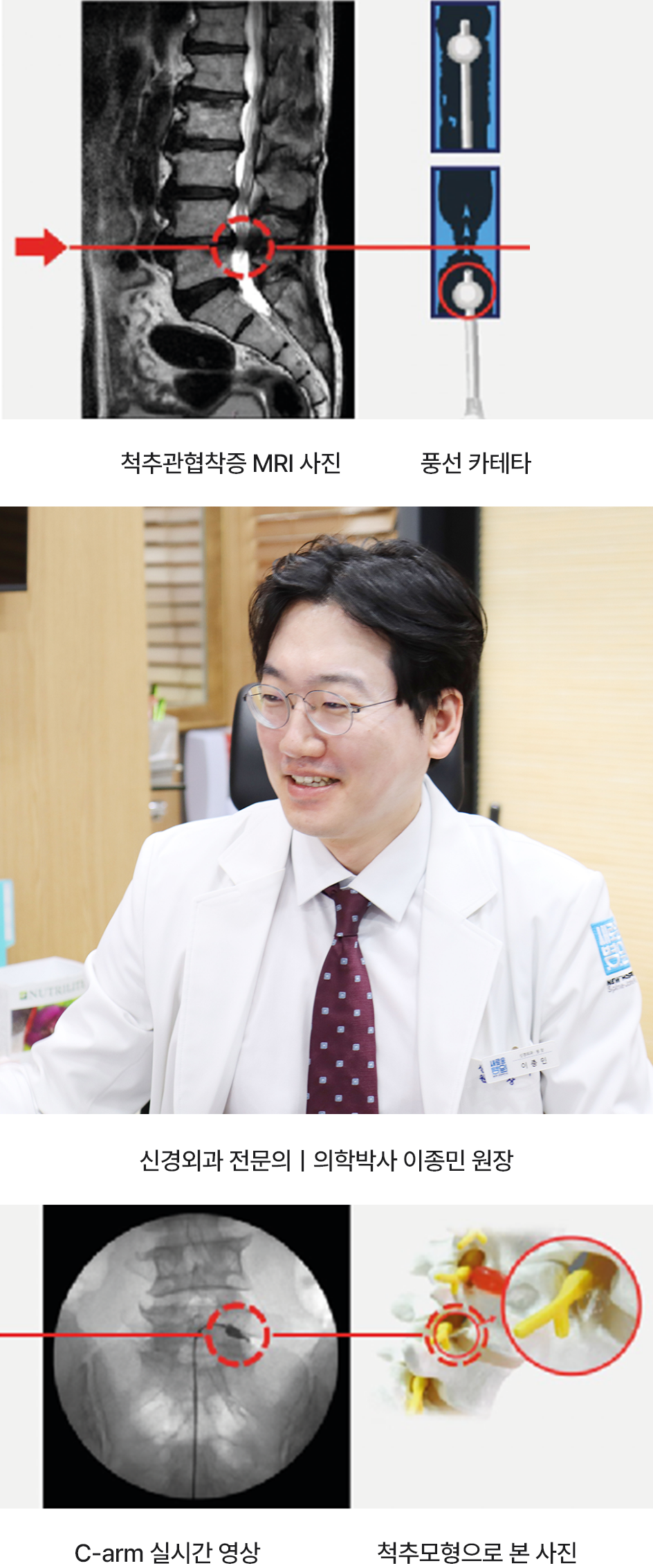 신경풍선확장술