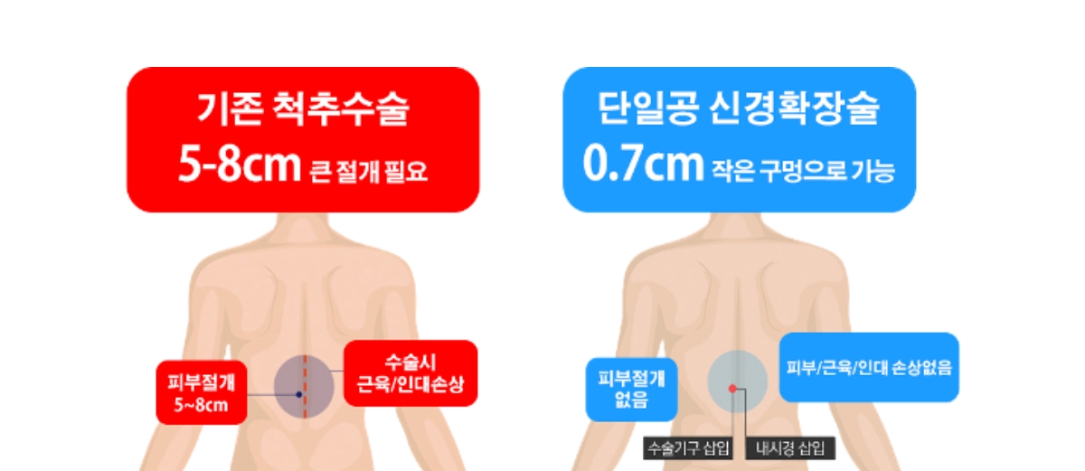 단일공내시경 허리질환