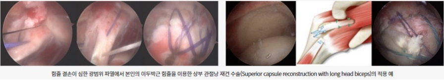 장두건 재건술