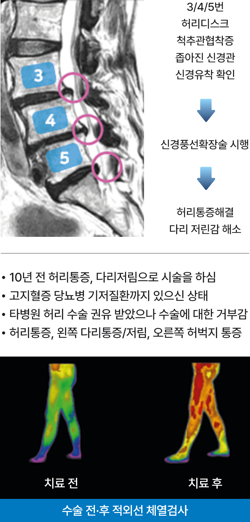 신경풍선확장술 예시