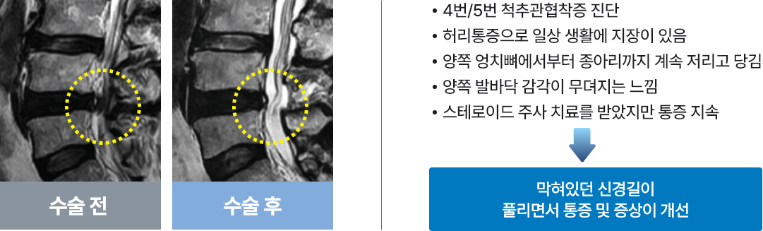 단일공 내시경 예시