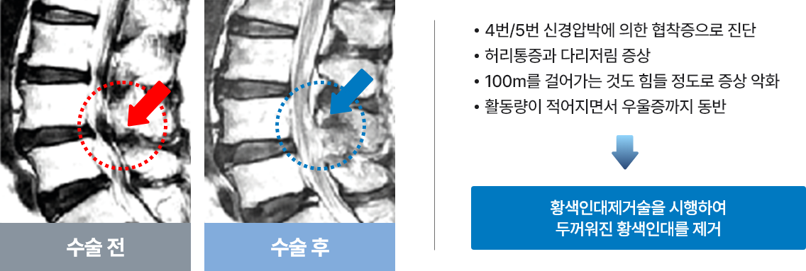 황색인대 제거술 예시