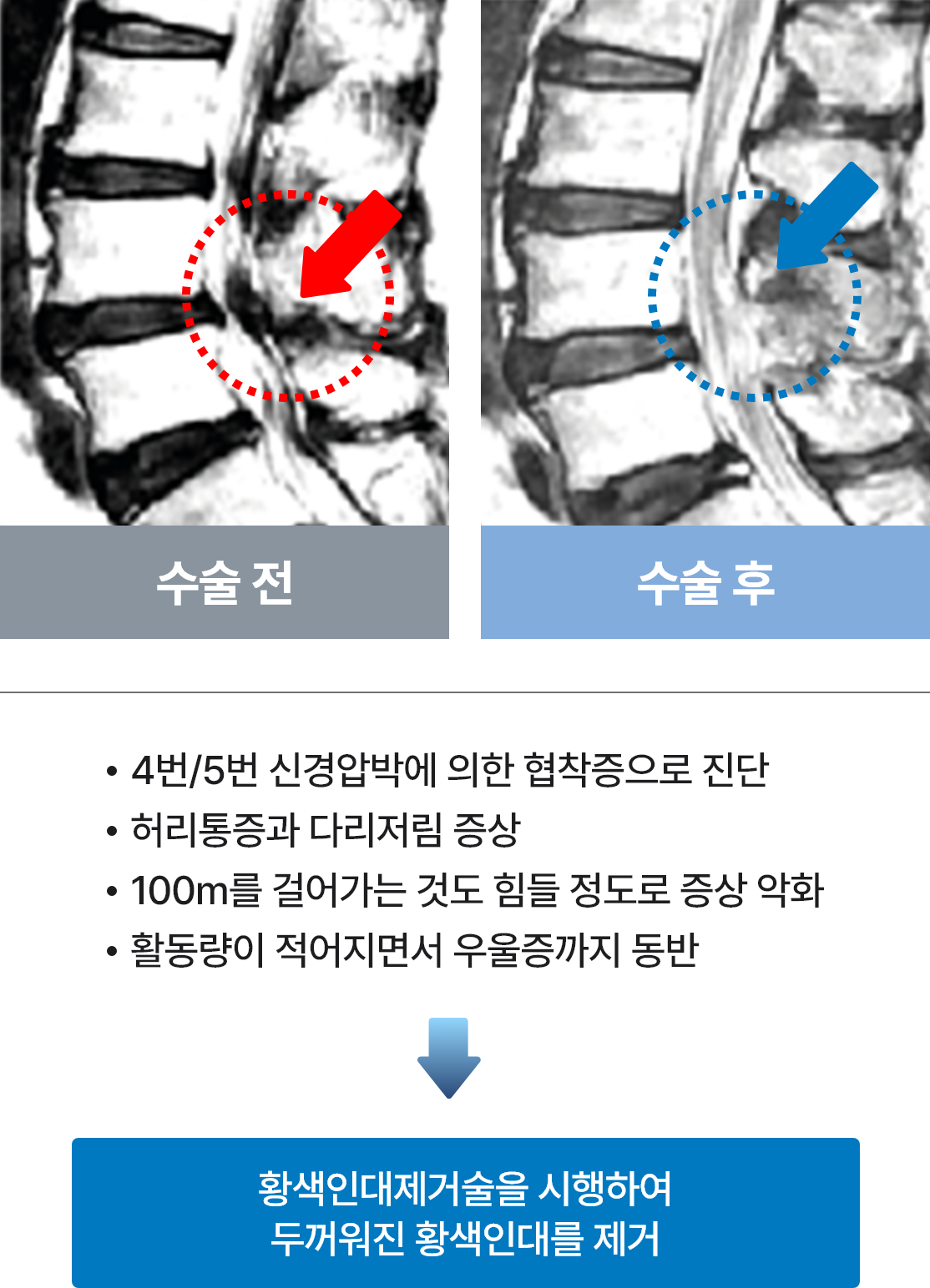 황색인대 제거술 예시