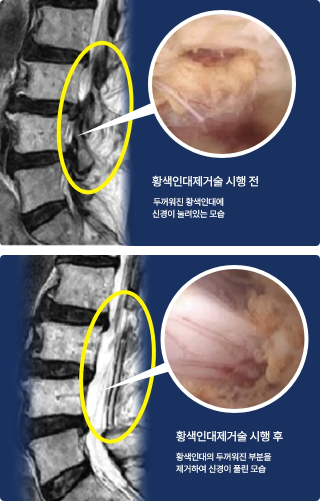 황식인대제거술 시행 전후